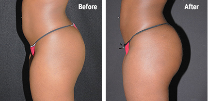 Brazilian Butt Lift